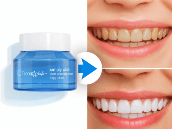 Bloom White Teeth Whitening before after